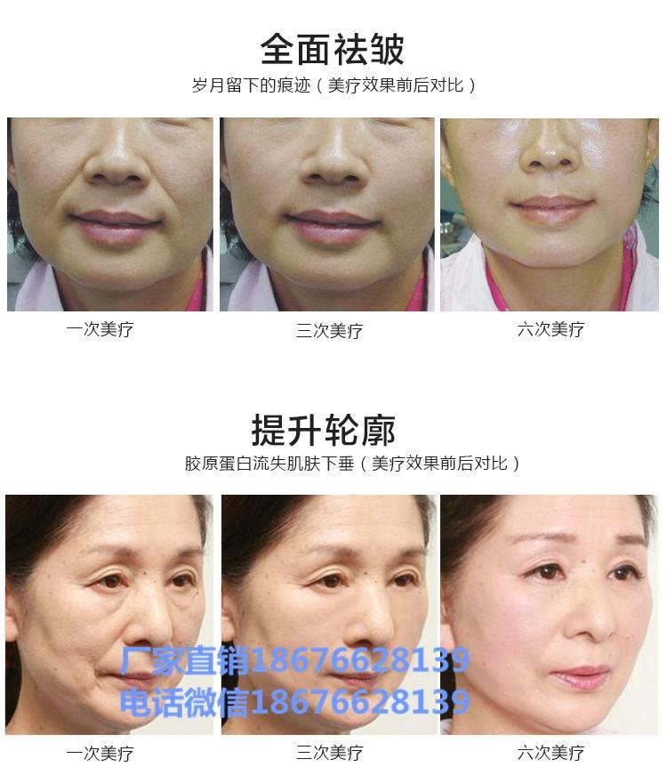 雷达线雕雷达精雕是什么,效果怎么样