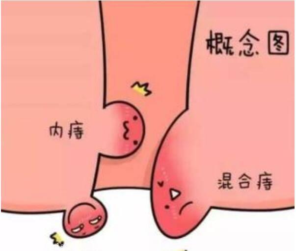 治痔疮的药哪种最好,有相当一部分痔疮患者,特别是内痔加重到二期
