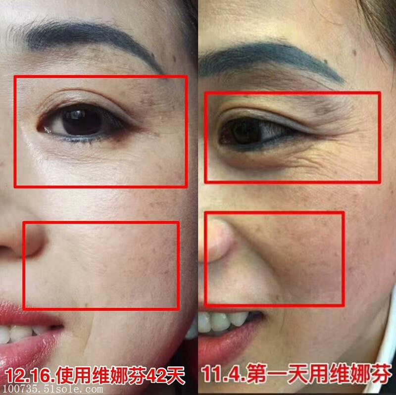 维娜芬好用吗,维娜芬有什么优点,维娜芬主要成分是什么,小嫣