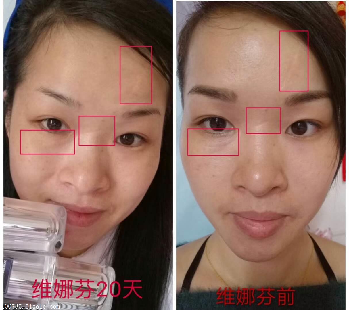 卓美斯维娜芬效果好用吗