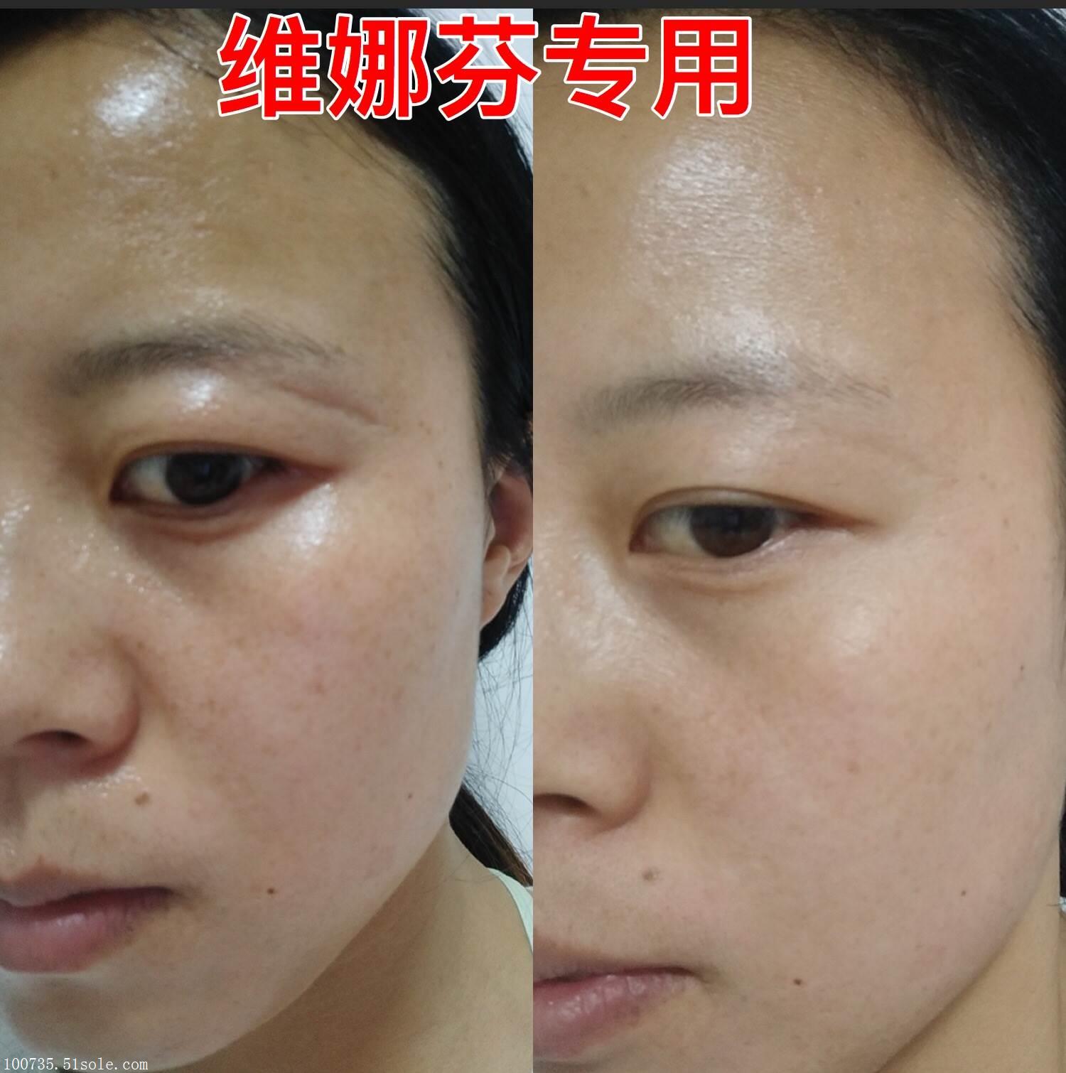 卓美斯维娜芬,维娜芬适合所有肤质吗,维娜芬好用吗,总代小嫣