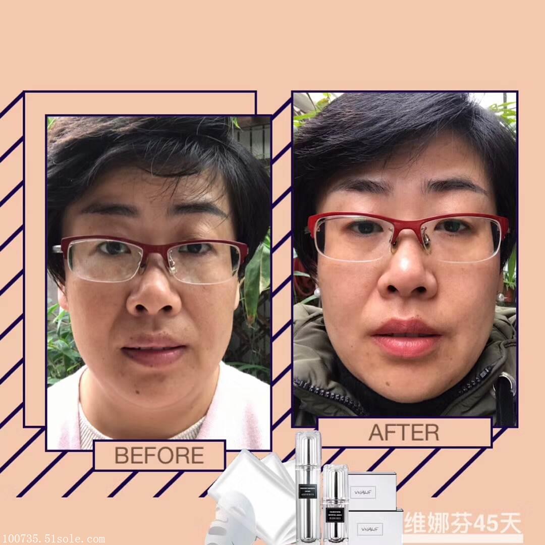 维娜芬为什么效果这么好,维娜芬有没有副作用,维娜芬能代理吗