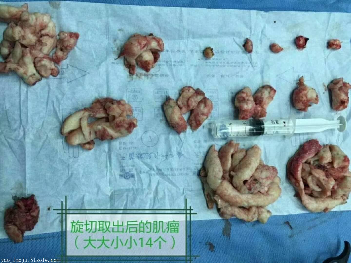 子宫肌瘤5cm必须手术吗危害多佳茵可以让肌瘤缩小消失