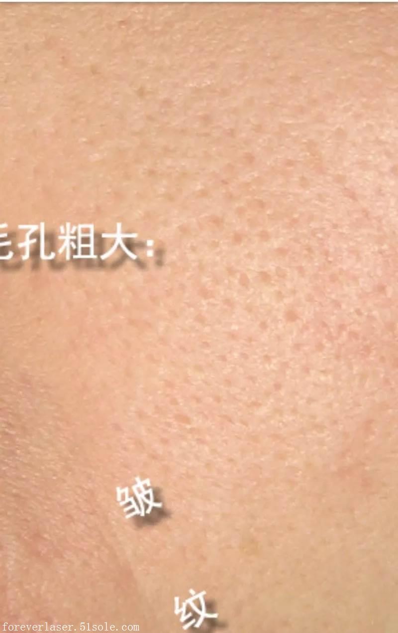 毛孔粗大不可逆吗