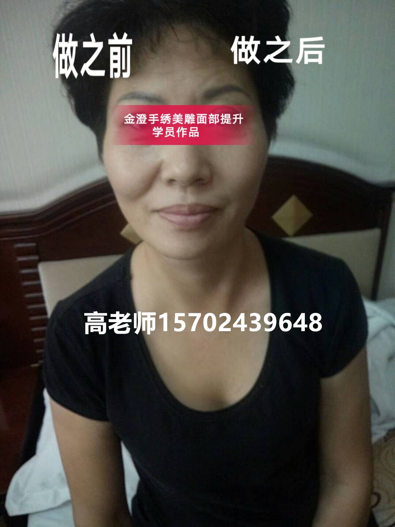 绿色美雕技术中医针灸微整