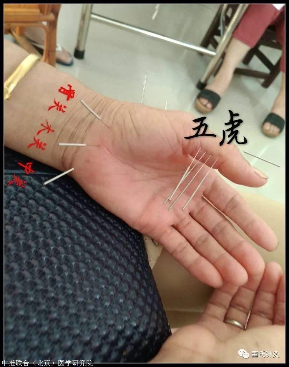 董氏针灸培训 三肩穴讲解 董针穴位大全