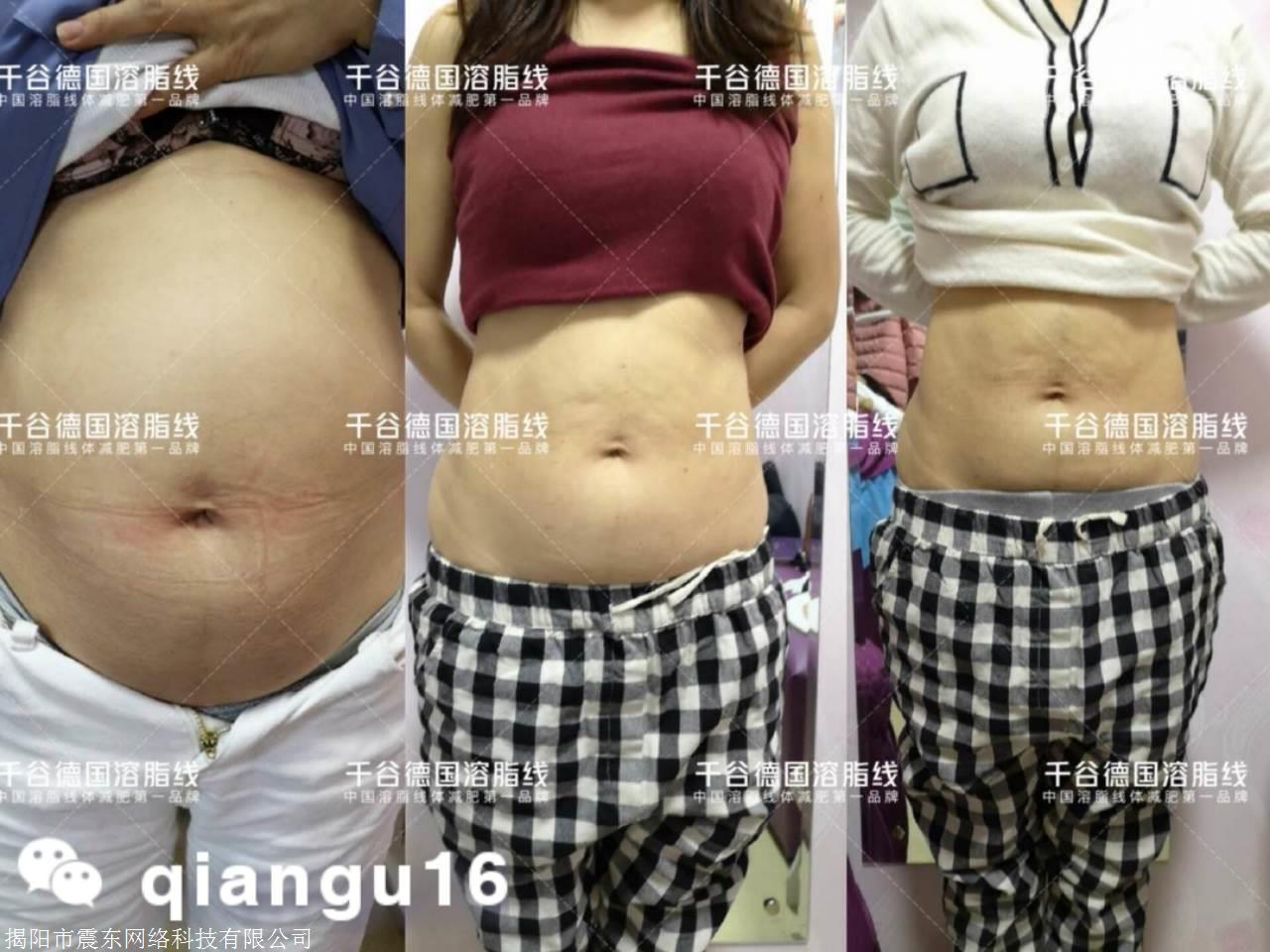 千谷德国溶脂线减肥一个疗程需要多少钱