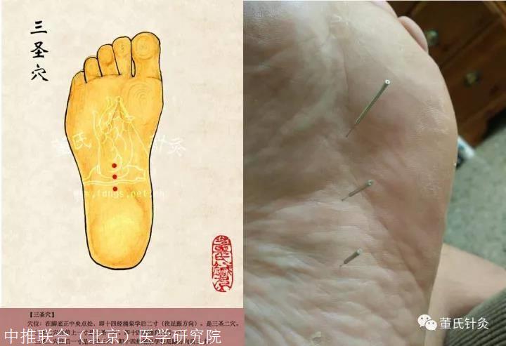 中医针灸培训班 董氏针灸高血压处方讲解
