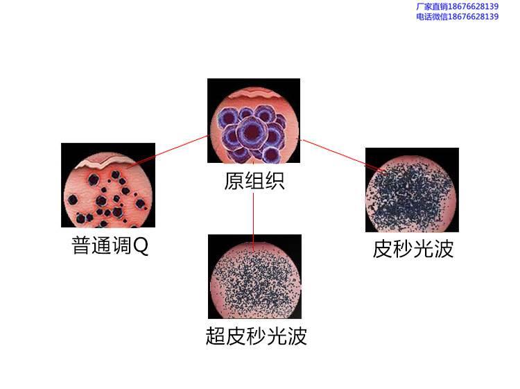 皮秒激光祛斑价格多少钱一次 皮秒祛斑一般要