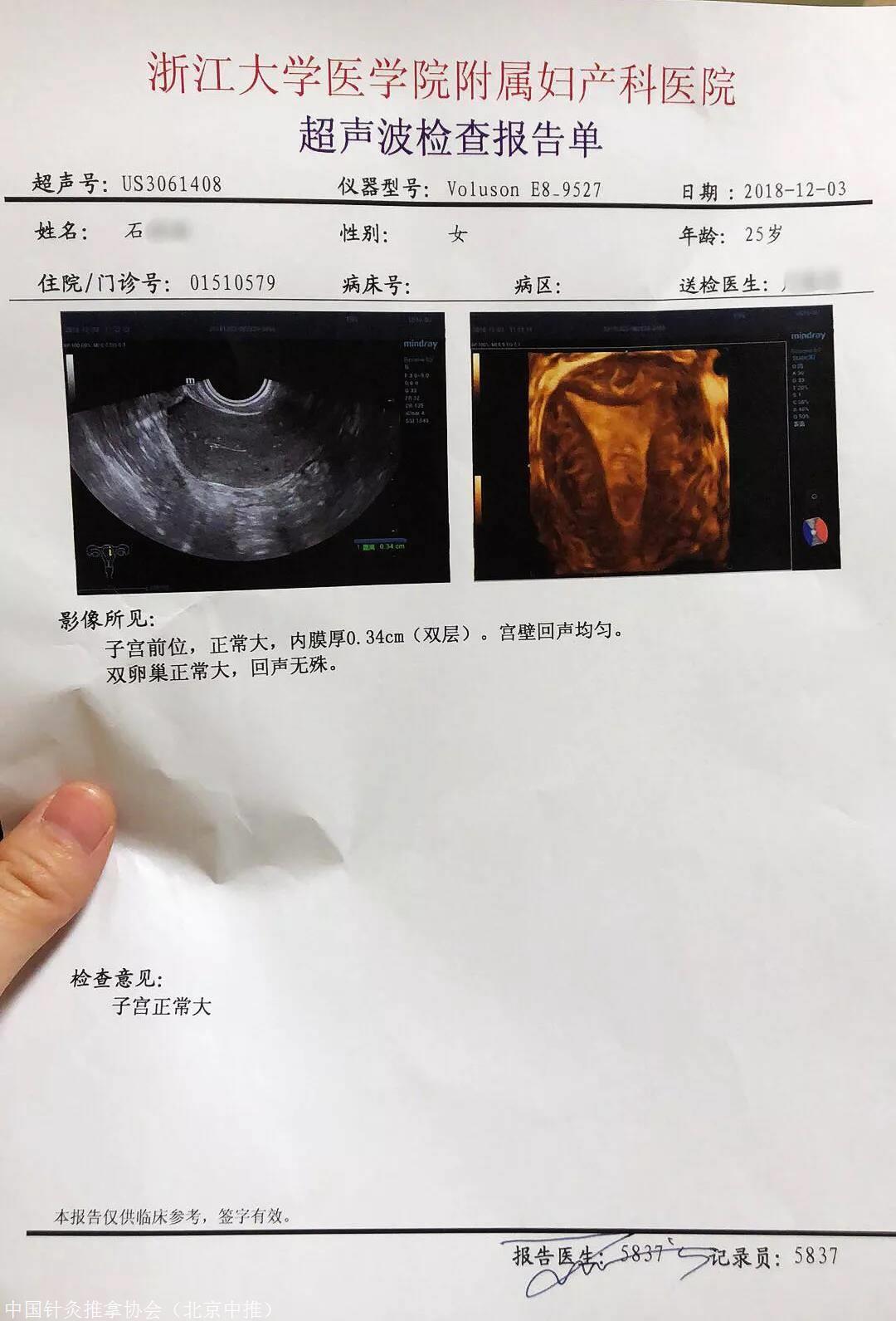 夏连红针灸培训 脐针治疗子宫内膜息肉