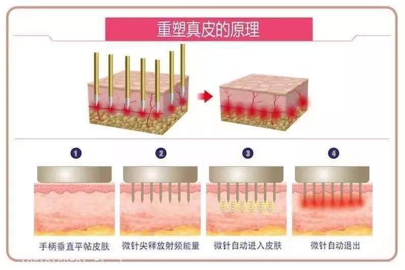 【深圳黄针射频微针仪器批发商】价格,厂家,其他光学仪器-搜了网