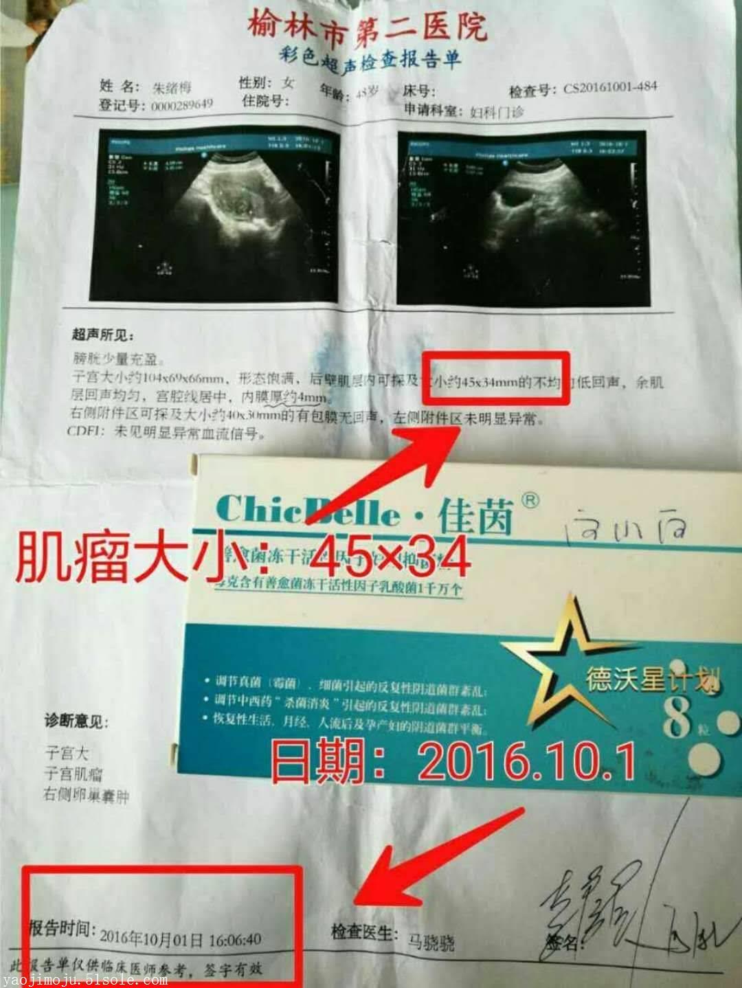 子宮肌瘤5cm必須手術嗎危害多佳茵可以讓肌瘤縮小消失