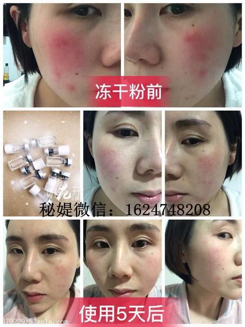 秘媞修复冻干粉效果怎么样多少钱用多久见效