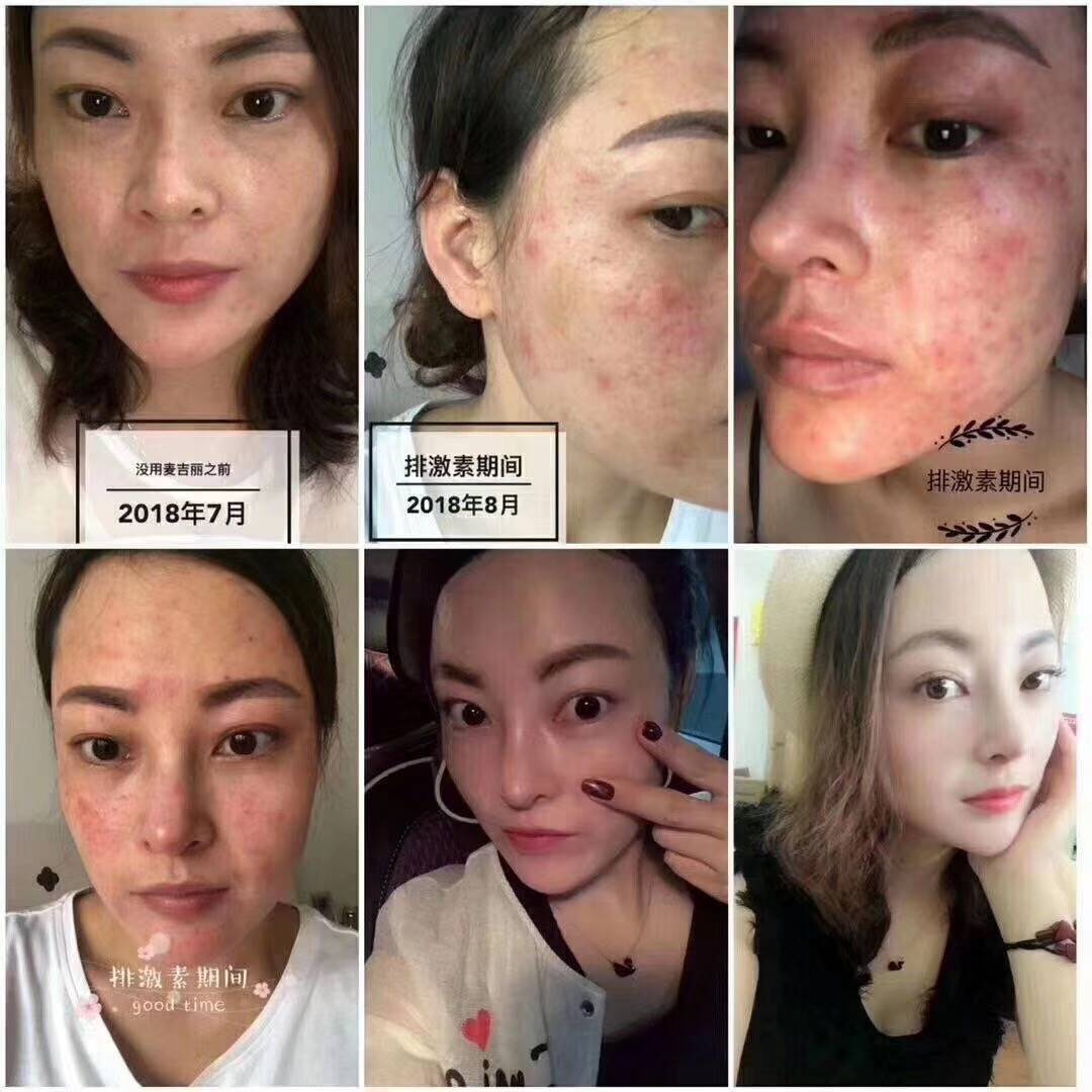 麦吉丽修复效果太夸张了吧朋友的激素脸好了