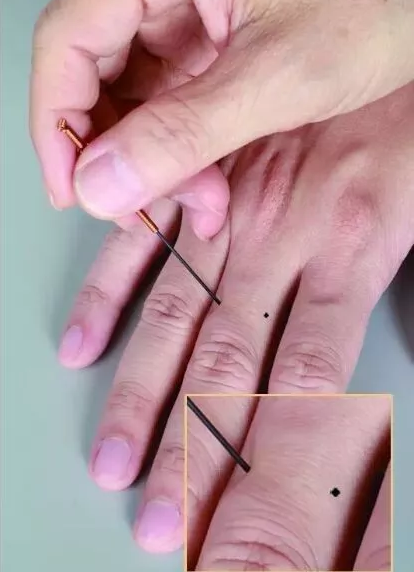 董氏奇穴针灸全集第四章