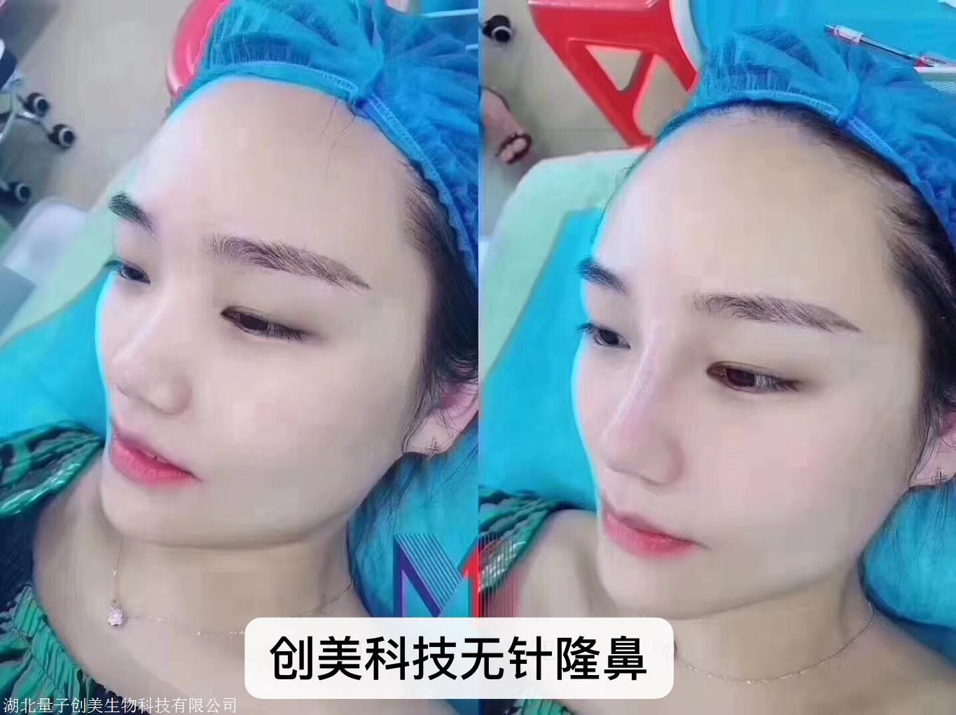 创美科技无针微整加盟优势_搜了网