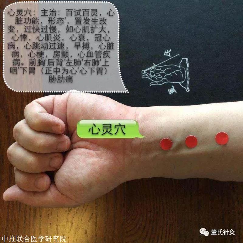 董氏针灸之心灵穴处方