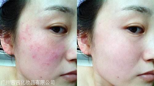 广州信誉度好医用面膜oem代加工敏感肌红血丝选面膜必须认准械字号